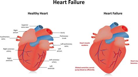 severe hypokinesis